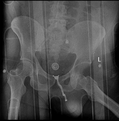 Anterior-posterior (AP) pelvic X-ray demonstrating an inferior dislocation of the left hip (luxatio erecta femoris). The left femoral head is displaced inferiorly and medially relative to the acetabulum, positioned near the obturator foramen. The left femur is abducted, and the femoral shaft is oriented horizontally/superiorly compared to the neutral right femur. In contrast, the right hip joint shows normal articulation with the femoral head centered within the acetabulum. No acute fractures of the pelvic ring, acetabulum, or proximal femurs are visible. Metallic artifacts are present, including a zipper-like structure and circular fasteners (likely from clothing or medical monitoring equipment) overlying the pelvic midline and lateral soft tissues. Vertical radiopaque lines across the image suggest a spinal board or transport device. This image serves as a clinical example of traumatic hip dislocation and its characteristic radiographic appearance.