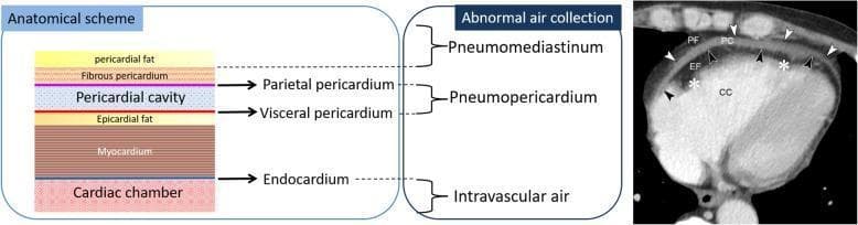 This composite educational graphic details the anatomy of the pericardium and its clinical presentation on imaging. The left side features a color-coded 'Anatomical scheme' illustrating the histological layers from external to internal: pericardial fat, fibrous pericardium, parietal pericardium, pericardial cavity, visceral pericardium (epicardium), epicardial fat, myocardium, endocardium, and cardiac chamber. A central panel correlates these anatomical spaces with specific pathologies of abnormal air collection: pneumomediastinum (superior to the parietal pericardium), pneumopericardium (within the pericardial cavity), and intravascular air (within the cardiac chamber). The right side shows a diagnostic axial chest CT image of a 47-year-old male with chronic kidney disease. Labeled features include pericardial fat (PF), parietal pericardium (white arrowheads), pericardial cavity (PC) containing a fluid collection, visceral pericardium (black arrowheads), epicardial fat (EF), myocardium (white asterisks), and cardiac chamber (CC). The image serves as a reference for distinguishing normal anatomical layers from pathological fluid or air accumulation in cardiovascular imaging.
