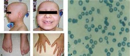 This composite image consists of clinical photographs and a diagnostic peripheral blood smear. Figure 1a (left) shows a pediatric patient with clinical signs including total alopecia (complete absence of scalp hair) and nail pitting affecting both hands and feet, characterized by small punctate depressions on the nail plates. Figure 1b (right) is a microscopic view of a peripheral blood smear demonstrating microangiopathic hemolytic anemia. Visible are numerous schistocytes—fragmented, irregular red blood cells including helmet cells and triangular forms—alongside some normal erythrocytes showing central pallor. The educational focus is on the multi-systemic manifestations of a medical condition, likely a microangiopathic process such as Hemolytic Uremic Syndrome (HUS) or similar systemic pathology, illustrating the correlation between dermatological signs (hair and nail changes) and hematological abnormalities (hemolysis and schistocytosis).