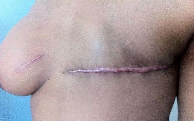 This clinical photograph displays the anterior chest wall of a female patient, illustrating two different types of surgical scars following breast cancer management. On the patient's left side (right side of image), there is a long, horizontal, slightly raised, and erythematous mastectomy scar that spans the width of the chest wall where the breast tissue has been removed. On the patient's right breast (left side of image), a smaller, linear, well-healed surgical scar is visible, consistent with a tumorectomy (lumpectomy). The mastectomy scar appears more hypertrophic and prominent compared to the shorter, flatter tumorectomy scar. The image serves as an educational tool for identifying postoperative clinical findings in breast surgery and understanding the visual outcomes of different surgical interventions for bilateral breast pathologies, such as multifocal lymphoma or sarcoma.