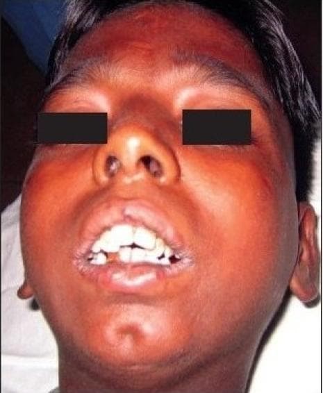 This clinical photograph is a preoperative view of a patient presenting with severe trismus secondary to bilateral temporomandibular joint (TMJ) ankylosis. The image focuses on the lower facial third, demonstrating a significantly restricted interincisor distance and minimal mouth opening. The maxillary and mandibular teeth are only slightly separated, showing visible dental crowding and malalignment. Facilitating the diagnosis of TMJ ankylosis, the facial profile exhibits a degree of micrognathia and retrognathia with a characteristic receding chin, often referred to as 'bird-face deformity' in bilateral cases. The soft tissues around the perioral region appear taut, and there is a noticeable fullness in the cheek regions. This visual serves as a textbook example of the functional and aesthetic impact of chronic TMJ fusion on jaw mobility and facial development in younger patients, commonly necessitating surgical intervention like interpositional arthroplasty.