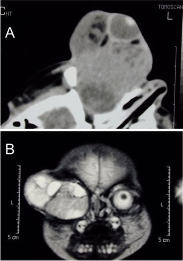 Diagnostic imaging of a neonatal orbital teratoma presenting as severe proptosis. Panel A is an axial non-contrast CT scan of the orbits showing a large, heterogeneous, solid-and-cystic mass completely occupying the right orbital cavity. The mass causes significant expansion of the orbit and anterior displacement (proptosis) of the globe, which appears engulfed by the lesion. No obvious bony destruction or calcifications are visible at this level. Panel B is a coronal T2-weighted MRI of the head and orbits. The tumor is predominantly hyperintense relative to the extraocular muscles and orbital fat, indicating high water content or cystic components within the mass. The MRI highlights the mass effect on surrounding structures, demonstrating total displacement of the right globe and extraocular muscles compared to the normal contralateral left orbit. This imaging is characteristic of a benign but locally aggressive congenital orbital teratoma, illustrating its typical radiological presentation of mixed density/intensity and mass-occupying effect in a newborn.