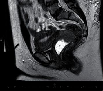 This diagnostic image is a T2-weighted sagittal MRI of the female pelvis, emphasizing the gynecological tract. The image utilizes gel distension of the vagina to enhance contrast and delineate vaginal anatomy. A well-defined mass of intermediate signal intensity is visible in the apical vaginal region, specifically at the superior vaginal fornix. The mass is positioned adjacent to the cervix and the inferior portion of the uterus. The uterus itself displays findings consistent with adenomyosis, characterized by a thickened junctional zone and heterogeneous myometrial signal. The hyperintense (bright) signal of the vaginal gel provides a clear interface against the intermediate-signal mass, assisting in the assessment of the lesion's morphology and its relationship to the vaginal walls. This imaging study is used in the clinical evaluation of pelvic masses, specifically for characterizing vaginal smooth muscle tumors and determining their extent relative to the bladder and rectum in a sagittal plane.