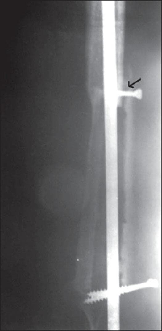 This diagnostic X-ray radiograph demonstrates a post-surgical resection arthrodesis of a long bone, typically the femur or tibia, following treatment for a giant cell tumor. The image shows a long, radio-opaque intramedullary (IM) nail spanning the medullary canal to provide structural stability. Two transverse interlocking screws are visible, securing the nail to the cortical bone. A distinct black arrow points to a localized radiolucent gap between the bone segments, signifying a nonunion of the bone graft at the 1.5-year postoperative follow-up. The surrounding bone shows irregular contours and variable density, indicating unsuccessful bony bridging and attempted remodeling at the graft-host interface. This visual serves as a clinical example of a complication in limb-salvage surgery and the failure of secondary arthrodesis using IM fixation.
