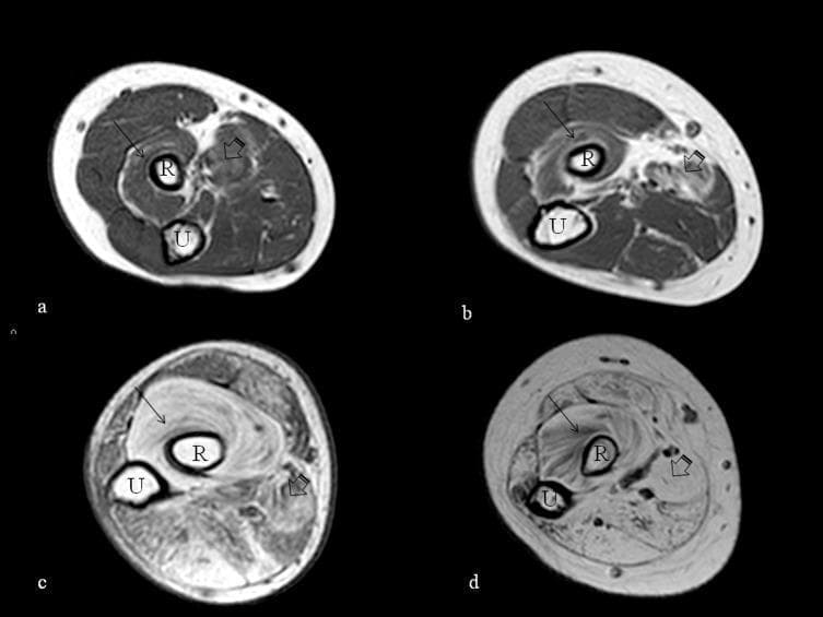 Diagnostic axial T1-weighted MRI images of the proximal forearm across four subjects (labeled a-d), demonstrating various stages of muscle fatty replacement. The cross-sections at the level of the radial tuberosity clearly show the radius (R) and ulna (U). In images 'a' and 'b' (younger ambulant patients), the musculature maintains relatively low signal intensity with preserved architectural definition, indicating mild involvement. In contrast, images 'c' and 'd' (older non-ambulant patients) exhibit progressive hyperintensity within the muscle compartments, characteristic of fatty infiltration. The supinator (indicated by arrows) and the pronator teres (indicated by arrowheads) show the most marked high signal intensity, particularly in image 'd', where normal muscle texture is replaced by bright fatty tissue. This comparison serves as a clinical illustration of disease progression in muscular dystrophies or similar neuromuscular conditions, where increased T1 signal serves as a biomarker for permanent muscle loss and functional decline.