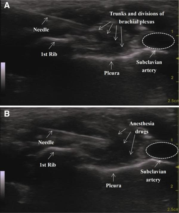 This diagnostic ultrasound image comparison (panels A and B) illustrates a supraclavicular brachial plexus block (SC-BPB) procedure. In Panel A (pre-injection), the cross-sectional anatomy of the supraclavicular fossa is shown, identifying the subclavian artery as a round, anechoic (hypoechoic) structure positioned superior to the first rib. The trunks and divisions of the brachial plexus are visible as a cluster of hypoechoic, honeycomb-like structures lateral to the artery. A hyperechoic linear needle is visualized approaching the nerve cluster. Key landmarks include the hyperechoic line of the first rib with posterior acoustic shadowing and the bright hyperechoic line of the pleura located deeper and medially. In Panel B (post-injection), the same anatomical region is shown after the administration of anesthesia drugs. A significant accumulation of hypoechoic fluid (anesthetic) is seen surrounding and hydro-dissecting the brachial plexus trunks, which confirms successful drug distribution around the target neural structures. This visual comparison is used for teaching regional anesthesia techniques, specifically ultrasound-guided nerve localization and monitoring of local anesthetic spread.
