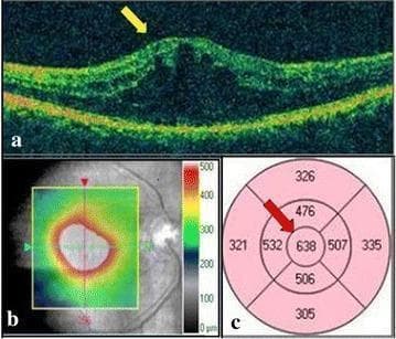 A three-part composite diagnostic image showing Spectral Domain Optical Coherence Tomography (SD-OCT) findings for Diabetic Macular Edema (DME). Panel (a) presents a horizontal cross-sectional OCT B-scan demonstrating significant foveal thickening with intraretinal cystic spaces and altered reflectivity, highlighted by a yellow arrow, indicating cystoid macular edema. Panel (b) shows a 6x6 mm macular cube thickness overlay map; the color scale (green to red) indicates topographic retinal thickness, with a large central red/white area signifying severe thickening exceeding 500 µm. Panel (c) displays an Early Treatment Diabetic Retinopathy Study (ETDRS) grid map providing quantitative data. A red arrow points to the central subfield, which shows a significantly elevated retinal thickness of 638 µm. This clinical visual illustrates the diagnostic hallmarks used in ophthalmology to assess the severity of diabetic retinopathy and macular fluid accumulation.