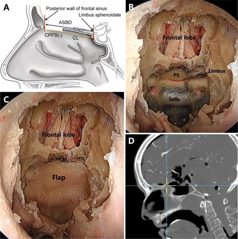 This composite image illustrates the surgical anatomy and reconstruction of the anterior skull base (ASB) following sphenoidotomy. Panel A is a sagittal anatomical diagram showing the relationship between the posterior wall of the frontal sinus and the limbus sphenoidale. It defines key surgical measurements: Anterior Skull Base Distance (ASBD), Coverage from the Limbus (CL), and Coverage at the Posterior wall of the Frontal Sinus (CPFS). Panels B and C are intraoperative 0-degree endoscopic views. Panel B shows the exposed surgical field with the frontal lobe, planum sphenoidale (PS), limbus, and sella turcica visible. Panel C demonstrates the subsequent placement of a pedicled nasoseptal flap (PNSF) over the ASB defect. Panel D is a sagittal CT-based navigation image used to confirm the spatial orientation and the endpoint of flap coverage relative to landmarks like the frontal and sphenoid sinuses. This educational material is designed for skull base surgeons to visualize the reach and limitations of nasoseptal flaps in endoscopic endonasal approaches.
