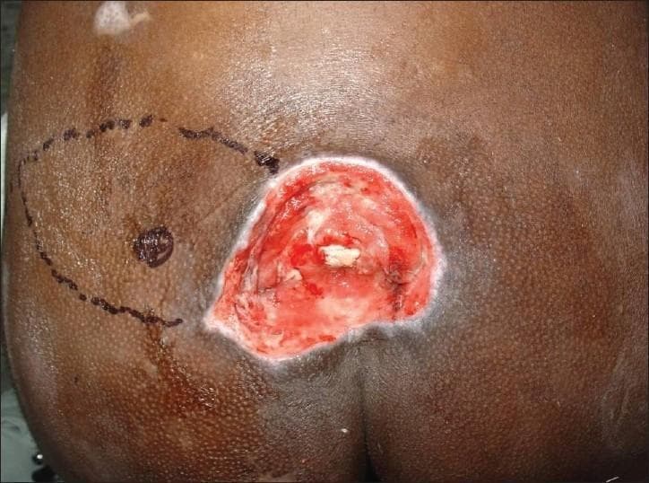Clinical photograph of a Grade IV sacral pressure sore on a patient with dark skin. The image demonstrates a deep, roughly oval-shaped ulcer in the sacral region. The wound bed shows extensive tissue loss with visible red granulation tissue and central areas of white-yellowish tissue, consistent with slough or exposed deep structures such as fascia or bone. The wound margins are irregular and slightly raised, with pale, macerated edges. The periwound skin exhibits hyperpigmentation and inflammatory changes. Adjacent to the ulcer, on the left side of the image, surgical markings are present, including a dashed curvilinear line and a central circular mark, indicating preoperative planning for a reconstructive skin flap (such as a superior gluteal artery perforator flap). The photograph serves as a visual reference for chronic wound assessment, staging of pressure injuries, and surgical flap design in plastic and reconstructive surgery.