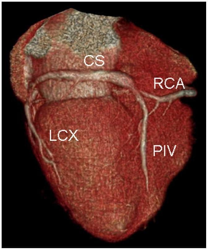 This diagnostic image is a volume-rendered CT reconstruction of the heart, focusing on the posterior anatomy of the coronary venous system and its relationship to the coronary arteries. Key anatomical structures labeled include the coronary sinus (CS), which appears as a prominent vessel in the atrioventricular groove, the right coronary artery (RCA), the left circumflex artery (LCX), and the posterior interventricular vein (PIV). The image specifically demonstrates a clinical scenario relevant to cardiac resynchronization therapy (CRT) planning. It highlights an anatomical variation characterized by multiple thin and short posterior cardiac veins. The absence of a large-caliber, dominant target veinโsuch as a robust posterolateral veinโrepresents a challenging or contraindicated site for the placement of left ventricular pacing leads. This visualization is used in advanced cardiology and radiology to assess patient suitability for CRT and to map the coronary venous anatomy to avoid complications like phrenic nerve stimulation or lead instability during device implantation.