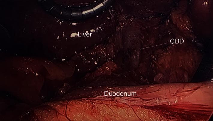 This intraoperative clinical photograph captures the hepatobiliary anatomy during a laparoscopic procedure. The image highlights a rare case of gallbladder agenesis, demonstrated by the conspicuous absence of the gallbladder in its expected location within the gallbladder fossa. The liver is visible in the superior aspect of the frame, exhibiting a smooth, dark reddish-brown surface with a characteristic glistening reflection. An arrow identifies the common bile duct (CBD), which appears as a vertical tubular structure in the hepatoduodenal ligament. Situated inferiorly is the duodenum, presenting as a larger, pinkish-red tubular organ with visible surface vasculature. The image serves as an educational reference for hepatobiliary surgical anatomy and the visual diagnosis of congenital gallbladder absence. Key structures labeled include the liver, common bile duct (CBD), and duodenum, emphasizing their spatial relationships when the gallbladder is naturally absent.