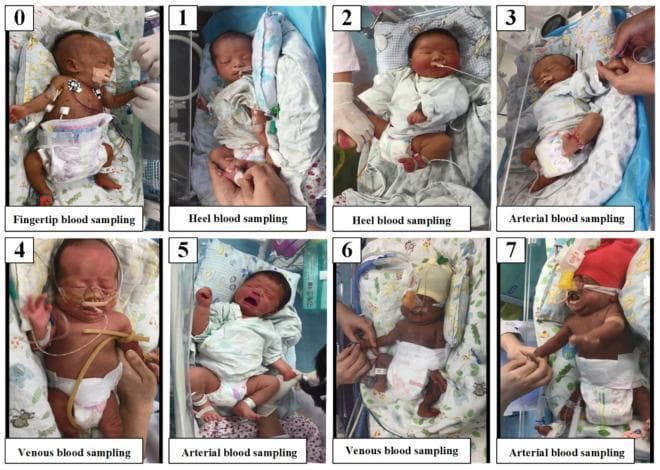 A series of eight clinical photographs (labeled 0-7) documenting various blood sampling procedures performed on neonates in a hospital setting, used to study neonatal pain responses. The images illustrate four distinct sampling modalities: fingertip (0), heel (1, 2), venous (4, 6), and arterial (3, 5, 7) blood collection. The infants are depicted in neonatal intensive care or nursery environments, showing varying degrees of medical support including nasogastric tubes, oxygen cannulae, chest leads for cardiac monitoring, and pulse oximetry sensors. The newborns exhibit a range of behavioral and physiological pain indicators, most notably facial grimacing and crying, particularly evident during arterial sampling in images 5 and 7. Healthcare personnel are shown performing the procedures at different anatomical sites such as the hands, heels, and antecubital fossa. This visual data supports the assessment of the Neonatal Infant Pain Scale (NIPS) and the development of automated pain recognition systems.