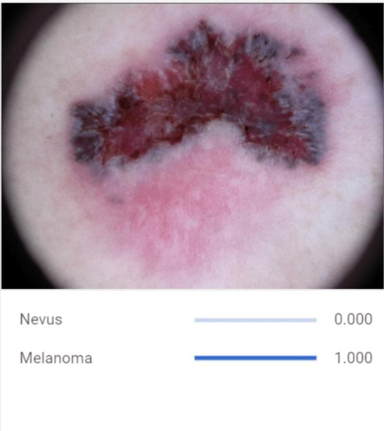 This clinical diagnostic image is a dermoscopic photograph of a malignant melanoma skin lesion, presented alongside a convolutional neural network (CNN) classification output. The lesion demonstrates the classic ABCDE criteria of melanoma: it is highly asymmetrical in shape with irregular, notched, and poorly defined borders. The lesion exhibits significant color variegation, featuring a complex distribution of dark brown, reddish-pink, and focal blue-gray areas. The blue-gray hues are concentrated primarily at the periphery, while the interior shows mixed erythematous and brown pigmentation. Surrounding the primary lesion is a faint pinkish macular area, possibly representing inflammation or regression. The diagnostic significance of this image is to highlight visual biomarkers used in automated dermatological assessment, specifically emphasizing the irregular morphology and multi-chromatic nature of malignant pigmented lesions compared to benign nevi. Below the clinical image, an AI diagnostic tool indicates a probability score of 1.000 for melanoma and 0.000 for nevus, illustrating the application of machine learning in computer-aided diagnosis for dermatology.
