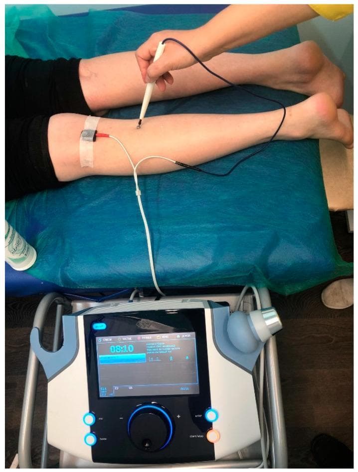 This clinical photograph illustrates a procedural setup for Low-Frequency Transcutaneous Electrical Nerve Stimulation (LF TENS) of the tibial nerve. The subject is positioned prone on a medical table. A stationary rectangular cathode is fixed with white adhesive tape over the nerve in the popliteal fossa of the lower leg. A clinician is shown manually applying a mobile, pen-like anode electrode, moving it along the posterior calf in a proximal-to-distal direction to target the nerve pathway. Both electrodes are connected to a digital medical stimulation device positioned in the foreground. The device interface displays a timer (08:10), wave parameters, and clinical settings regulated by a large central rotary dial and illuminated functional buttons. This procedure is commonly utilized in physical therapy and neurology for managing neuropathic pain, such as diabetic painful distal axonal neuropathy, by inducing painless muscle contractions to modulate pain perception.