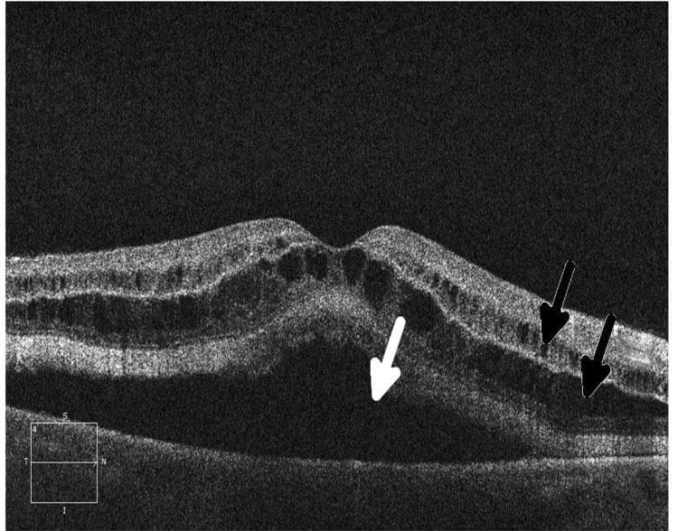 This diagnostic image is a cross-sectional Optical Coherence Tomography (OCT) scan of the human retina, demonstrating drug-induced retinopathy secondary to MEK inhibitor therapy. The scan shows significant disruption of normal macular architecture characterized by both intraretinal and subretinal fluid accumulation. Intraretinal fluid is visible as multiple, hyporeflective (dark), oval-shaped cystic spaces located within the inner retinal layers, leading to increased retinal thickness. Subretinal fluid is identified as a large, homogeneous hyporeflective area beneath the neurosensory retina, causing a serous retinal detachment from the underlying retinal pigment epithelium (RPE). The foveal contour is distorted by the elevation of the neurosensory layers. Black arrows highlight the intraretinal cystic changes, while a white arrow points to the subretinal fluid collection. This imaging is characteristic of MEK inhibitor-associated retinopathy, an important side effect in ophthalmology and oncology for medical students and clinicians to recognize.