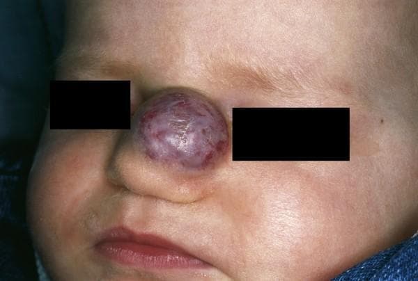 This clinical photograph displays a close-up view of an infant's face featuring a prominent vascular lesion on the nose. The lesion is identified as an infantile hemangioma, a common benign vascular tumor of childhood. Located on the nasal dorsum and extending toward the nasal tip, the tumor is a well-circumscribed, globular, and exophytic mass that significantly distorts the underlying nasal contour. Its color is variegated, showing shades of deep red and violet with surface telangiectasia, indicative of a high density of blood vessels. The surface texture is largely smooth and slightly translucent, with subtle lobulations visible under the skin. The surrounding facial skin on the cheeks, forehead, and bridge of the nose appears fair and unremarkable, without secondary signs of ulceration or additional satellite lesions. This visual represents a 'Cyrano nose' deformity, highlighting the clinical presentation of focal-type infantile hemangiomas which, if left untreated during the proliferative phase, can lead to permanent structural distortion of nasal cartilage or airway obstruction.