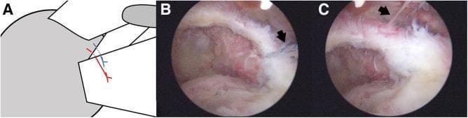 This composite educational material demonstrates the surgical management of a subscapularis tendon tear in the right shoulder, specifically focusing on the 'comma tissue' repair. Panel A provides an anatomical line diagram illustrating the relationship between the humeral head, subscapularis, and the arc-shaped comma tissue (superior glenohumeral ligament/coracohumeral ligament complex). Panel B is an arthroscopic image showing the subacromial space after initial subscapularis repair; two retained blue suture limbs (black arrow) are visible near the irregularly textured comma tissue. Panel C shows the same arthroscopic view following the completion of the comma tissue repair. The sutures (black arrow) have been passed through the tissue using an antegrade suture passer, effectively securing the comma tissue to the repaired tendon complex. This technique is used to restore the anatomical stability of the rotator cuff. The images demonstrate key landmarks including the humeral head, the subscapularis tendon stump, and the fibrous comma sign, highlighting the transition from initial suture retention to final tissue fixation.