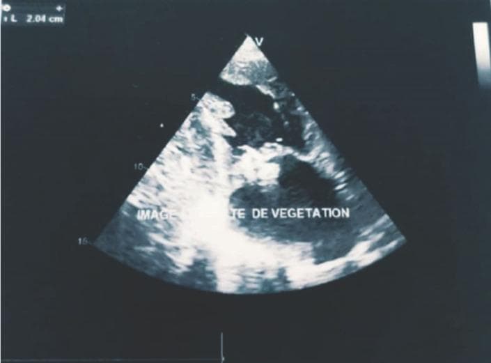 This diagnostic image is a transthoracic echocardiogram in a parasternal long-axis view showing the cardiac chambers. The primary finding is a large, irregularly shaped, echogenic mass attached to the anterior leaflet of the mitral valve, consistent with infective endocarditis vegetation. A digital measurement caliper at the top left indicates a size of approximately 2.04 cm (20 mm). The vegetation appears mobile and occupies a significant portion of the mitral valve apparatus, which is clinically associated with severe mitral regurgitation and a high risk of embolic events. The image demonstrates the classic sonographic appearance of valvular vegetation used for diagnosing infective endocarditis according to the Modified Duke Criteria. Key anatomical landmarks visible include the left atrium, left ventricle, and the mitral valve leaflets.