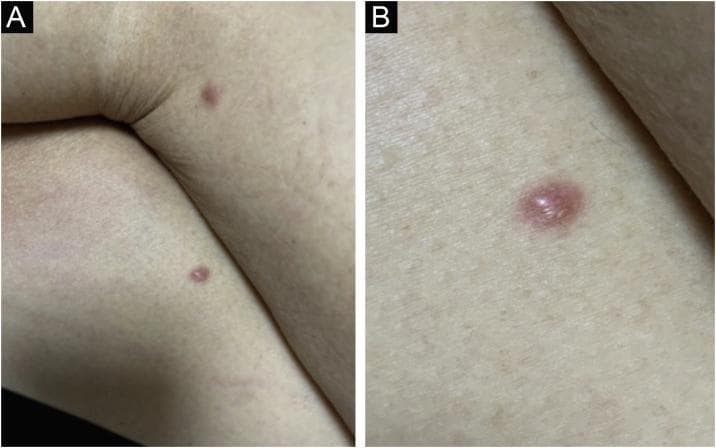 Two-part clinical photograph showing cutaneous manifestations of leukemia cutis in a patient with Acute Myeloid Leukemia (AML). Panel A presents a wide-angle view of the lower extremities, specifically the thighs, showing two isolated, discrete erythematous papules. Panel B provides a high-magnification close-up of a single lesion. The lesions are characterized as smooth-surfaced, rounded, and infiltrated (hardened) papules with a reddish, erythematous hue. They are well-demarcated from the surrounding healthy skin. These findings represent a recurrence of systemic leukemia following an allogeneic bone marrow transplant (BMT). The imagery illustrates the typical clinical presentation of extramedullary leukemic infiltration, which can be polymorphic and non-pathognomonic, requiring clinical correlation and biopsy for definitive diagnosis. The educational focus is on identifying skin-colored to erythematous papulonodular lesions as a sign of systemic hematologic malignancy progression or relapse.