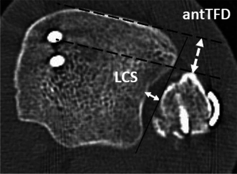 This diagnostic image is an axial (transversal) CT scan of a left ankle, taken approximately 10 mm proximal to the tibial plafond. It demonstrates post-operative osteosynthesis hardware and provides a visual guide for measuring distal tibio-fibular syndesmotic alignment. The image shows the distal tibia and fibula with metallic implants: the lateral malleolus is stabilized by two screws, while the medial malleolus shows a plate-and-screw construct. Educational annotations illustrate two critical 2D measurement parameters: the tibio-fibular clear space (LCS), shown as the horizontal distance between the lateral border of the posterior tibial incisura and the medial border of the fibula; and the anterior tibio-fibular distance (antTFD), represented by the dashed double-arrow line measuring the interval between the anterior tibial tubercle and the anterior aspect of the fibula. Reference lines indicate the anatomical landmarks used to standardize these measurements, which are essential for evaluating syndesmotic reduction and identifying post-operative malalignment such as diastasis or fibular translation. This material is designed for orthopedic surgery and radiology education to assess the quality of ankle fracture fixation.