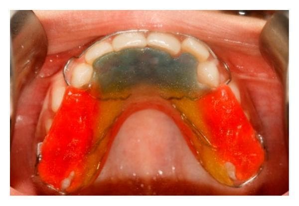 This clinical intraoral photograph displays a removable maxillary orthodontic appliance in situ, designed for the treatment of Class III skeletal patterns and anterior crossbite. The appliance features a multi-colored acrylic baseplate covering the palate, with a clear/translucent anterior section adapted to the lingual surfaces of the incisors, transitioning to yellow and bright red posterior segments. These posterior acrylic blocks are typically utilized for bite opening or anchorage. A stainless steel framework is visible, including Adams clasps and wire loops bent to facilitate the attachment of orthopedic elastics for maxillary protraction or retraction. The appliance is shown in relation to the upper dentition and palatal mucosa, demonstrating precise adaptation. This visual serves as an educational example of functional or interceptive orthodontic appliances used in pediatric or adolescent patients with maxillary deficiency.