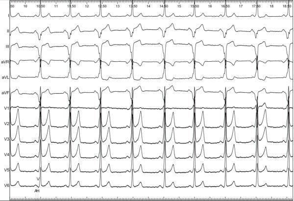 This diagnostic image is a 12-lead electrocardiogram (ECG) demonstrating ventricular preexcitation characteristic of Wolff-Parkinson-White (WPW) syndrome. The tracing shows a short PR interval and prominent delta waves at the onset of the QRS complexes. Specifically, positive delta waves are visible in the precordial leads (V1 through V6), resulting in a dominant R-wave pattern in V1, which suggests an accessory pathway (AP) located on the left side of the heart. In the inferior leads (II, III, and aVF), the delta waves are negative (downward deflections), resembling pathological Q waves; this 'pseudoinfarction' pattern indicates the vector of initial ventricular activation is moving away from the inferior wall, highly suggestive of a left posteroseptal accessory pathway. The highest negative delta wave amplitudes are seen in leads II and III. This ECG is a classic educational example for identifying and localizing bypass tracts based on delta wave polarity and QRS morphology in patients with symptomatic or asymptomatic preexcitation.