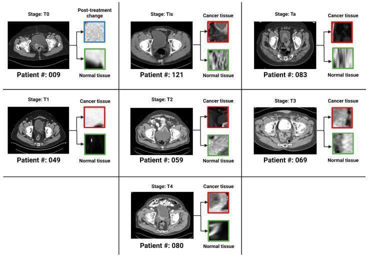 This diagnostic comparison chart displays seven panels of axial pelvic CT scans with intravenous contrast, each illustrating a specific TNM stage of urothelial carcinoma (T0, Tis, Ta, T1, T2, T3, and T4). For each stage, a full axial section of the pelvis is shown alongside two magnified Regions of Interest (ROIs) extracted from the bladder wall. The ROIs are categorized as either 'Cancer tissue' (highlighted in red or blue for post-treatment changes) or 'Normal tissue' (highlighted in green), providing a visual basis for histopathological and radiological correlation. The progression demonstrates key staging features: non-muscle invasive stages (Ta, Tis, T1) show localized bladder wall irregularities, while muscle-invasive stages (T2-T4) exhibit increasing wall thickening, loss of clear margins, and infiltration into the perivesical fat or adjacent structures, as seen in the T3 and T4 examples. This educational visual is designed for training in radiological staging of bladder cancer and development of machine-learning classification models for oncology.