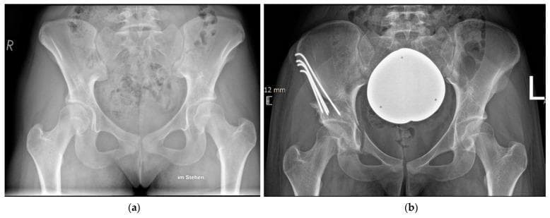 This figure presents a side-by-side comparison of anteroposterior (AP) pelvic radiographs demonstrating the surgical management of developmental dysplasia of the hip (DDH). Image (a) shows the preoperative state with bilateral acetabular dysplasia, characterized by a shallow acetabular roof and insufficient coverage of the femoral head. Image (b) displays the postoperative result following a periacetabular osteotomy (PAO) of the right hip. The acetabulum has been surgically reoriented to increase the lateral center-edge angle (LCEA) and improve superior femoral head coverage. Internal fixation is visible in the right ilium, consisting of four metallic Kirschner wires (K-wires) that are bent at their proximal ends and recessed into the iliac crest to secure the osteotomized fragment. A large, spherical radiopaque marker or artifact is visible over the pelvic midline in the postoperative view. This diagnostic comparison highlights the anatomical corrections achieved through reorientation osteotomy and the use of unthreaded K-wires as an alternative fixation method to traditional screws.