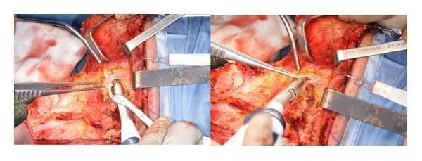 This clinical photograph displays an intraoperative view of a neck dissection, specifically focusing on levels II and III. The image shows a side-by-side comparison of surgical maneuvers using an Ultracision harmonic scalpel. In the surgical field, multiple metal retractors are positioned to provide exposure of the deep cervical structures, including the plane of the internal jugular vein and the sternocleidomastoid muscle. The white, curved-tip harmonic scalpel is seen actively engaging with the facial vessels for ultrasonic sealing and dissection. Forceps are used concurrently for tissue manipulation and tension. The surrounding tissue demonstrates detailed dissection of fibrofatty and muscular layers, with the blue surgical drape defining the sterile perimeter. This visual serves to illustrate advanced hemostatic techniques in otolaryngological surgery, highlighting the replacement of conventional hand-tie ligation with harmonic technology for vessel sealing and tissue coagulation.