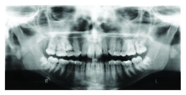This diagnostic image is a pretreatment panoramic radiograph (orthopantomogram) of a 17-year-old female patient, illustrating significant dental impactions and malocclusion. The radiograph reveals a full permanent dentition with three primary areas of impaction: both mandibular third molars are horizontally impacted against the distal aspect of the second molars, and the maxillary right second premolar is impacted in a high superior position near the floor of the maxillary sinus. The dental alignment demonstrates signs of irregularity and crowding, particularly in the anterior regions, consistent with a clinical diagnosis of Class III malocclusion. The maxillary arch appears constricted, while the mandibular arch shows slight anterior crowding. Supporting anatomical structures, including the mandibular condyles, ramus, and maxillary sinuses, are visible. This imaging is clinically significant for orthodontic and orthognathic surgical planning, providing a comprehensive view of tooth angulation and the spatial relationship between impacted elements and surrounding bone.