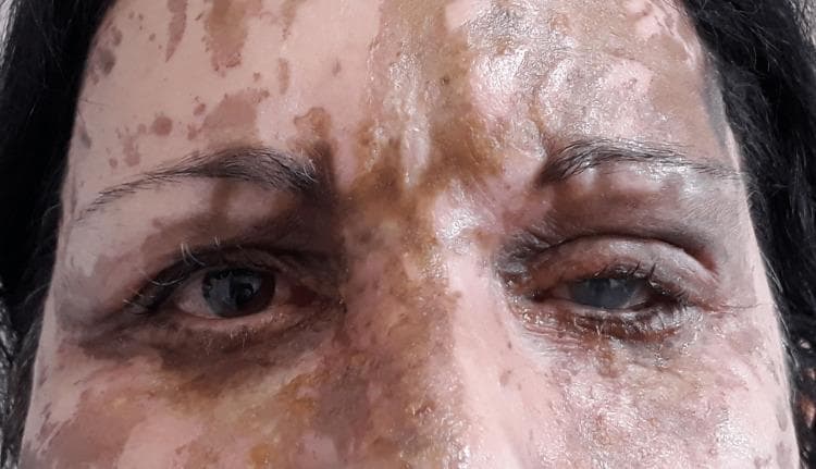 This clinical photograph displays chemical facial burns on a 45-year-old patient, captured on the third post-burn day. The cutaneous injury exhibits a characteristic 'marble cake' or 'trickle' pattern, with irregular, linear, and patchy hyperpigmented areas interspersed with islands of unaffected skin. The burn coloration ranges from light tan and golden-brown to dark brown and blackish-brown, typical of sulfuric acid-induced coagulation necrosis. The ocular region is significantly involved; the left eye shows marked corneal opacity (leukoma), conjunctival injection, and periocular edema with darkening of the eyelid skin. The right eye appears less severely affected but maintains periocular involvement. Key educational features include the visualization of mixed-depth chemical burns, where superficial and deep partial-thickness areas coexist, and the acute ophthalmic complications following acidic liquid exposure. This image is relevant for surgical burn assessment, emergency medicine, and ophthalmology, illustrating why chemical burns often require delayed depth reassessment due to their evolving nature and non-uniform distribution.