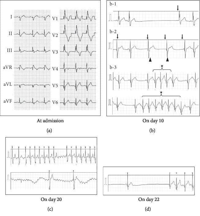 A composite clinical diagnostic image showing four sets of electrocardiogram (ECG) strips (a-d) tracking a patient's cardiac rhythm progression. (a) A standard 12-lead admission ECG demonstrating a regular sinus rhythm with a complete right bundle branch block (RBBB), characterized by rsR' patterns in V1-V2 and wide S waves in leads I and V6. (b) Multiple rhythm strips from day 10 showing sinus arrest (b-1), junctional escape rhythms with retrograde P waves indicated by arrowheads (b-2), and short bursts of non-sustained atrial tachycardia marked with stars (b-3). (c) Rhythm strips from day 20 demonstrating atrial flutter with a characteristic sawtooth baseline and variable atrioventricular (AV) conduction ratios ranging from 2:1 to 4:1. (d) A rhythm strip from day 22 showing a significant sinus arrest lasting approximately 5.7 seconds, followed by a slow junctional escape beat. This visual sequence is representative of sick sinus syndrome or complex cardiac conduction disturbances, illustrating the transition between bradyarrhythmias and tachyarrhythmias (tachy-brady syndrome).