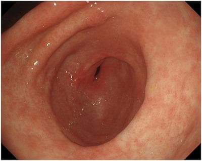 This gastroscopic image displays a view of the gastric mucosa, likely within the antrum, showing a relatively healthy appearance following the resolution of prior pathology. The mucosa is characterized by a uniform pinkish-red color with a smooth, glistening surface and normal vascular patterns. There is a distinct absence of the diffuse erythema, edematous thickening, or wall rigidity often associated with scirrhous gastric cancer or ectopic pancreas-related inflammation. The gastric folds appear supple and undistended. In the center, the gastric lumen and the pyloric orifice are visible and patent, with no evidence of stenosis, mass effect, or significant mucosal irregularities. This image serves as a clinical reference for the interval regression of gastric wall thickening in a patient being monitored for recurrent epigastric symptoms.