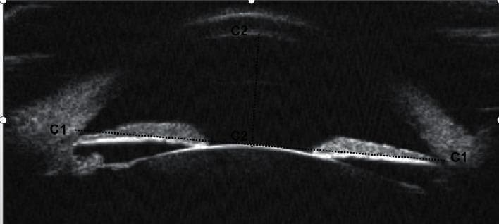 This diagnostic image is an Ultrasound Biomicroscopy (UBM) scan providing a panoramic, cross-sectional view of the human eye's anterior segment. The high-frequency ultrasound reveals key anatomical structures including the cornea, anterior chamber, iris, and the anterior surface of the crystalline lens. Two primary biometry measurements used in ophthalmology and glaucoma assessment are highlighted: 1) Anterior Chamber Width (ACW), labeled as 'C1', represents the horizontal distance between the two scleral spurs; 2) Anterior Chamber Depth (ACD), labeled as 'C2', represents the vertical distance from the corneal endothelium to the anterior pole of the lens. The image illustrates the spatial relationship between the cornea, lens, and iris, which is critical for evaluating the anterior chamber angle and risks associated with angle-closure glaucoma. This clinical imaging modality is essential for visualizing structures behind the iris pigment epithelium that are not visible via traditional slit-lamp biomicroscopy or gonioscopy.