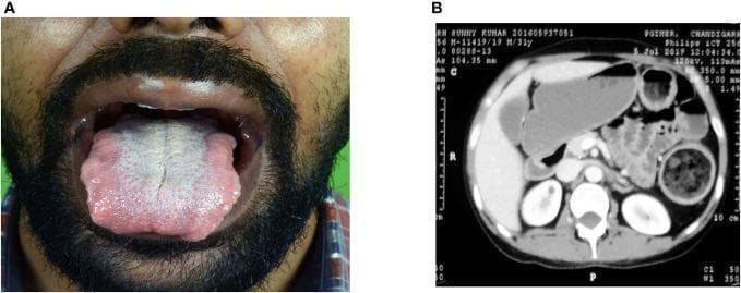 This multi-panel figure illustrates clinical manifestations of Multiple Endocrine Neoplasia (MEN) syndrome, specifically MEN2B. Panel A is a clinical photograph showing the oral cavity of a patient with a mucosal neuroma. The tongue is significantly enlarged (macroglossia) with characteristic nodular, irregular borders and a central whitish-yellow coating, typical of benign nerve sheath tumors associated with this genetic syndrome. Panel B is an axial contrast-enhanced abdominal CT scan demonstrating significant bowel pathology. Several loops of the small and large bowel are severely dilated and distended, consistent with chronic intestinal pseudo-obstruction or megacolon, which can occur due to intestinal ganglioneuromatosis in MEN2B patients. Other visualized anatomy includes the liver, kidneys, and vertebrae. Together, these images serve as educational examples of the extra-endocrine findings in MEN syndromes, highlighting the importance of physical examination of the oral mucosa and radiological assessment of the gastrointestinal tract in suspected cases.