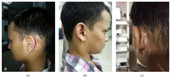 A series of three clinical photographs (a, b, c) demonstrating postoperative complications following ear surgery in a young adult. Panels (a) and (c) show the left postauricular region with clear evidence of wound dehiscence along a previous mastoidectomy incision site. There is active purulent discharge (pus) visible emanating from a focal opening in the wound, accompanied by perilesional erythema and inflammation of the surrounding skin. Panel (b) provides a lateral view of the right neck, highlighting significant soft tissue fullness and swelling in the upper cervical region, which disrupts the normal anatomical contour. These visual findings represent clinical manifestations of postoperative infection and parapharyngeal involvement, specifically highlighting mastoiditis-related complications and secondary abscess formation. This content is highly relevant for medical education concerning Otolaryngology (ENT), surgical site infections, and the diagnostic evaluation of cervical swellings following middle ear procedures.