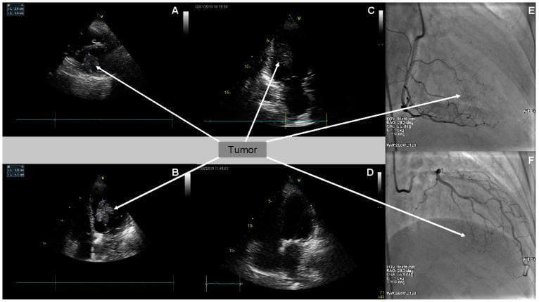 This composite figure illustrates the multi-modal diagnostic assessment and treatment response of a cardiac metastatic tumor, likely from melanoma. Panels A, B, and C display two-dimensional transthoracic echocardiography (2D TTE) in parasternal short-axis and apical four-chamber views. They reveal a large, well-defined, hyperechoic mass (arrows) situated within the left ventricle cavity, originating from the inferoseptal wall. Panel D shows a follow-up 2D TTE (4-chamber view) demonstrating complete tumor resolution following chemotherapy (pembrolizumab). Panels E and F present selective coronary angiography (CA) of the right coronary artery (RAO 28.3°, CAU 2.2°) and the left coronary artery circumflex branch (RAO 26.3°, CRA 23.1°). These images highlight sparse, poor tumor vascularity (arrows) during the late arterial phase, differentiating the mass from highly vascular primary cardiac tumors. This sequence serves as an educational tool for identifying metastatic cardiac lesions via echocardiography and angiography, as well as monitoring clinical response to immunotherapy.