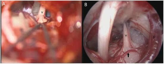 This side-by-side clinical comparison illustrates the differences between microscopic and endoscopic visualizations during microvascular decompression (MVD) surgery for trigeminal neuralgia. Image A displays the microscopic view through a retrosigmoid approach, showing the trigeminal nerve (v) partially visible within a narrow surgical corridor, with neurosurgical instruments in the foreground. Image B presents the endoscopic view of the same anatomical area, providing a wider perspective and superior depth perception. Key labeled structures in the endoscopic field include the trigeminal nerve (v), the superior petrosal vein (p) positioned to the right, and a hidden 'responsible artery' (indicated by a black arrow) located inferior to the nerve, which was not clearly visible under the microscope. This comparison highlights the educational concept of neuro-endoscopic superiority in identifying neurovascular conflict (NVC), particularly for vessels positioned on the dorsal or inferior aspects of the nerve that might be obscured by the restricted line-of-sight inherent to microscopic surgical views.