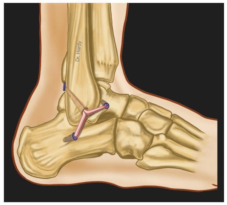 This medical anatomical diagram illustrates an anatomic surgical reconstruction of the lateral ankle ligament complex from a lateral view. The diagram depicts the skeletal structures of the distal fibula, talus, calcaneus, and tarsal bones. The primary focus is the surgical reconstruction of the three main lateral ligaments: the Anterior Talofibular Ligament (ATFL), the Calcaneofibular Ligament (CFL), and the Posterior Talofibular Ligament (PTFL). The reconstruction utilizes a split tendon autograft (such as a gracilis tendon) that is anchored to the distal fibula. The graft bifurcates and extends into three distinct limbs, which are secured into bone tunnels on the talus and calcaneus using blue-colored interference screws or anchors. This illustration demonstrates the surgical technique used to manage chronic lateral ankle instability by replicating the native anatomy of the lateral ligament complex to restore joint stability and biomechanical function.