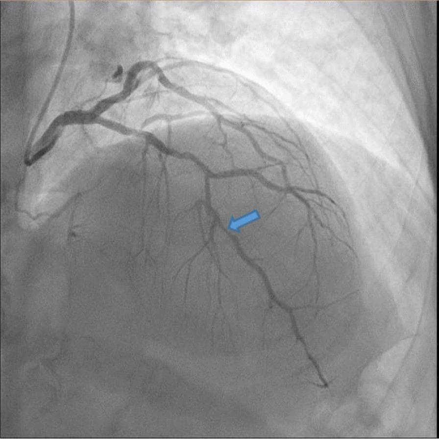 This diagnostic image is a coronary angiogram (fluoroscopic x-ray) of the left coronary arterial system. The image displays the left main coronary artery bifurcating into the left circumflex and the left anterior descending (LAD) artery, with subsequent branching into diagonal and septal perforator vessels. A blue arrow highlights a focal, high-grade obstructive lesion (approximately 90% stenosis) in the mid-segment of the left anterior descending artery. The stenosis is characterized by a significant narrowing of the contrast-filled lumen compared to the proximal and distal vessel diameters, indicating restricted blood flow. The background shows the silhouette of the heart and thoracic structures with pulmonary vascular markings. This visual serves as a critical educational example of atherosclerotic coronary artery disease and is used to assess the need for revascularization procedures like percutaneous coronary intervention (PCI) or coronary artery bypass grafting (CABG) in a clinical preoperative setting.