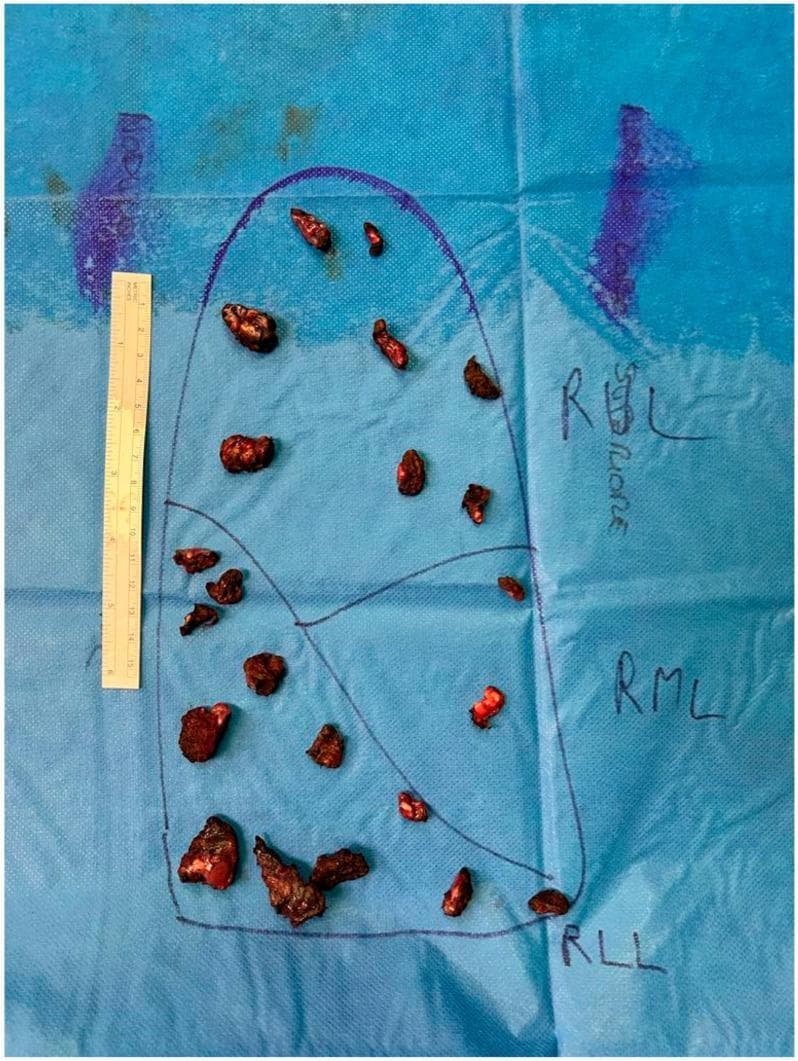 This clinical photograph illustrates a macroscopic intraoperative specimen mapping of multiple lung metastases. Set against a blue surgical drape, a diagrammatic representation of the right lung is hand-drawn, labeled with anatomical segments: RUL (Right Upper Lobe), RML (Right Middle Lobe), and RLL (Right Lower Lobe). Arranged within these marked zones are 25 dark, reddish-brown, irregular-shaped metastatic nodules, ranging from approximately 0.5 cm to 2.0 cm in size, exhibiting a firm, fleshy texture. A vertical metric ruler is positioned on the left side of the diagram for scale. This systematic arrangement is used in oncological thoracic surgery to assist pathologists in anatomical localization and histopathological assessment of multifocal metastatic disease. The image highlights the complexity of precision resections and the clinical importance of manual palpation and accurate anatomical orientation during pulmonary metastasectomy.