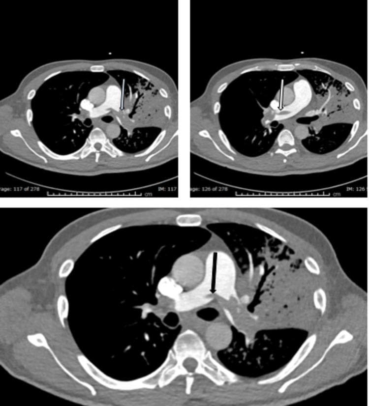 Diagnostic axial CT pulmonary angiogram (CTPA) of the chest demonstrating a saddle pulmonary embolism. The primary finding is a large, low-attenuation filling defect centrally located at the bifurcation of the main pulmonary artery, which extends into both the right and left pulmonary arteries (indicated by various colored arrows). The thrombus conforms to the vessel lumina, partially obstructing contrast flow. Additionally, the left lung parenchyma shows significant abnormalities, including dense consolidation and cavitary lesions in the left upper lobe, consistent with associated pulmonary infarction or underlying pathology. This diagnostic image is intended for intermediate to advanced medical education regarding acute vascular emergencies, pulmonary embolism classification, and cardiothoracic radiology interpretation.