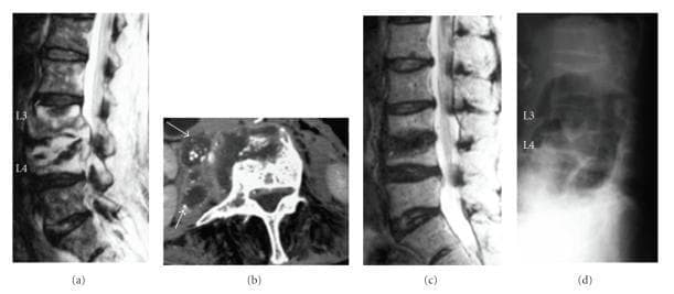 This composite of diagnostic images illustrates the longitudinal management of infectious spondylitis (likely tuberculous) in the lumbar spine. (a) Preoperative sagittal T2-weighted MRI shows signal hyperintensity between the L3 and L4 vertebral bodies and within the epidural space, indicative of an abscess with compression of the dural sac. (b) Preoperative axial contrast-enhanced CT displays multiple paravertebral abscesses (arrows) containing internal calcifications, a hallmark of tuberculous infection. (c) Follow-up sagittal T2-weighted MRI at 18 months postoperatively demonstrates resolution of the hyperintense abscess and normalization of the spinal canal. (d) Lateral plain radiography at 30 months postoperatively shows successful bone union and stabilization of the L3-L4 segment. The sequence highlights key diagnostic markers for spinal tuberculosis—including disc space involvement, epidural abscess formation, and intralesional calcification—and documents the radiographic progression from active infection to postoperative recovery and osseous fusion.