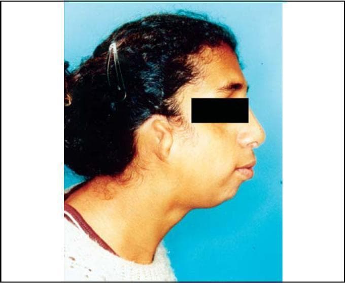 This clinical photograph shows a right-side profile view of an individual demonstrating the craniofacial manifestations of Treacher Collins Syndrome (mandibulofacial dysostosis). Key visible features include significant malar hypoplasia (underdevelopment of the zygomatic arch), which contributes to a flattened midface appearance. Marked mandibular hypoplasia (micrognathia) is evident, resulting in a receding chin and an altered facial profile. The external ear exhibits malformation of the auricular pinna (microtia), and while the eyes are partially obscured for privacy, the visible periocular region suggests an antimongoloid (downward) slanting of the palpebral fissures. These combined features are classic phenotypic markers of TCOF1, POLR1C, or POLR1D gene mutations. The photograph serves as an educational resource for identifying autosomal dominant disorders affecting the first and second branchial arch development, highlighting typical facial dysmorphism and associated skeletal abnormalities.