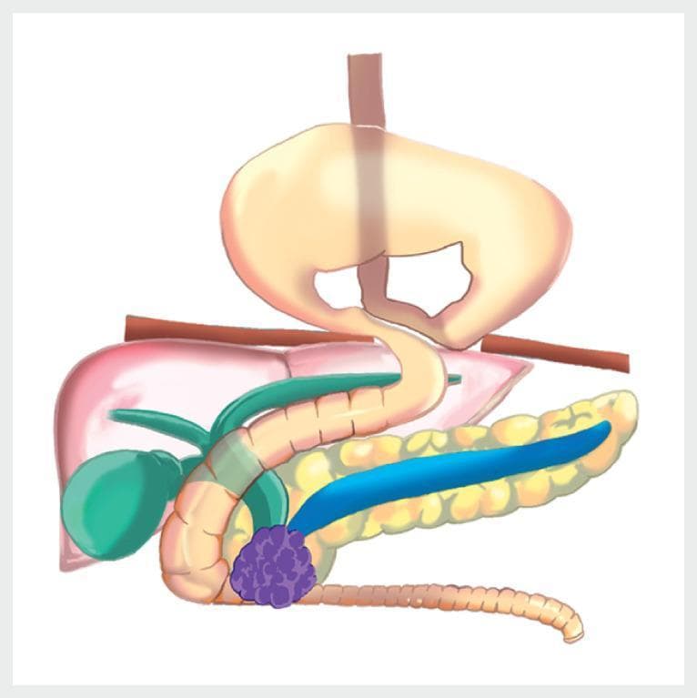 This medical anatomical diagram illustrates a complex surgical and pathological scenario involving the upper gastrointestinal and biliary systems. The image is divided by the diaphragm, showing a large hiatal hernia of the 'upside-down stomach' type, where the majority of the stomach has prolapsed into the thoracic cavity. Below the diaphragm, the abdominal anatomy includes the liver, gallbladder, and pancreas. A significant pathological finding is a purple, nodular mass located in the head of the pancreas, which is shown causing extrinsic compression of the distal common bile duct and the second portion of the duodenum. Additionally, the main pancreatic duct is depicted as dilated (highlighted in blue), indicating obstructive changes proximal to the tumor. The diagram provides clinical context for managing biliary and duodenal obstruction in the presence of severe anatomical distortion. This visual is suitable for gastroenterology and surgical oncology education, focusing on pancreatic malignancy and hiatal hernia complications.
