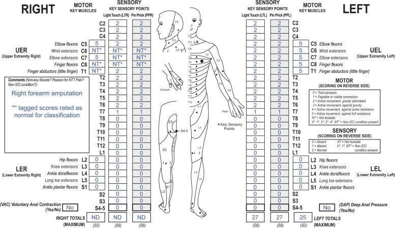 An ISNCSCI (International Standards for Neurological Classification of Spinal Cord Injury) assessment worksheet documenting a mid-thoracic spinal cord injury. The central diagram displays human dermatomes and key sensory points. The worksheet records bilateral motor and sensory scores (Light Touch and Pin Prick) from C2 to S4-5. In this specific clinical case, the right upper extremity sections (C6, C7, C8, and T1) contain 'NT*' (Not Testable) notations due to a right forearm amputation, with a comment indicating these should be treated as normal for classification purposes. Sensory and motor levels show normal function (score 2 or 5) down to T6, followed by impaired sensation (score 1) at T7 and complete loss of function (score 0) from T8 through the sacral segments. Sacral sparing indicators—Voluntary Anal Contraction (VAC) and Deep Anal Pressure (DAP)—are marked as 'No'. The image illustrates the methodology for classifying spinal cord injuries when confounded by non-SCI-related physical impairments like amputation.