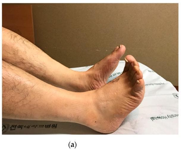 This clinical photograph shows the lower extremities of a 56-year-old male, highlighting signs of a peripheral nerve injury, specifically severe sciatic nerve palsy. The left foot (foreground) demonstrates characteristic 'foot drop' or equinus deformity, where the foot remains in a fixed plantarflexion position with an inability to actively dorsiflex. The skin on the dorsal aspect of the left foot and ankle appears dry, slightly erythematous, and thickened compared to the contralateral limb, suggesting possible autonomic dysfunction or chronic stasis. While the right foot maintains a more neutral posture, the left toes show subtle dorsal deviation. The legs appear otherwise symmetrical in size, with no gross muscle wasting visible from this angle. The visual findings correlate with the patient's clinical history of prolonged compression injury at the mid-thigh level, leading to downstream sensory and motor deficits. This image serves as a clinical example of the physical manifestations of high-level sciatic nerve injury and the secondary orthopedic complications such as equinus contracture.
