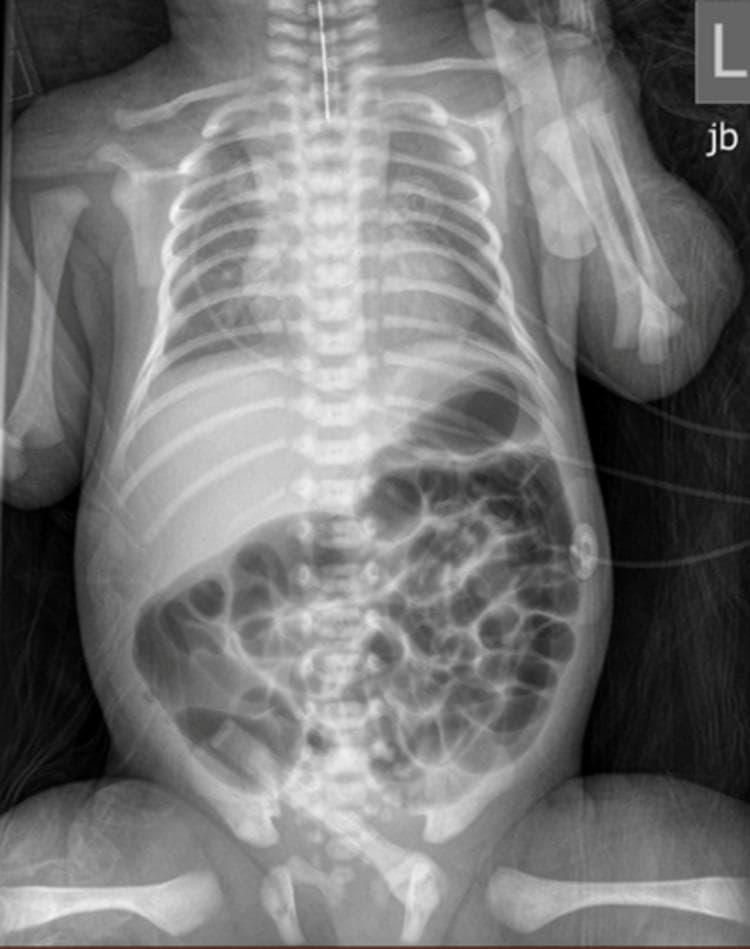 Anteroposterior (AP) neonatal chest and abdominal radiograph demonstrating diagnostic findings for esophageal atresia (EA) with an associated tracheoesophageal fistula (TEF). The primary finding is a radiopaque orogastric feeding tube that terminates abruptly in the proximal esophagus, visualized as a blind pouch in the upper mediastinum, indicating atresia. Despite the esophageal obstruction, there is significant bowel gas distributed throughout the stomach and small intestine in the abdomen. This presence of distal air confirms the existence of a distal tracheoesophageal fistula, allowing air to pass from the trachea into the lower gastrointestinal tract. The skeletal structures show normal neonatal development, and the abdominal gas pattern suggests patency distal to the stomach. This combination of a coiled or superiorly terminating feeding tube and subdiaphragmatic air is a classic radiological sign used in pediatric surgery to classify Type C esophageal atresia. The image is a critical educational example for neonatal intensive care and pediatric radiology training.