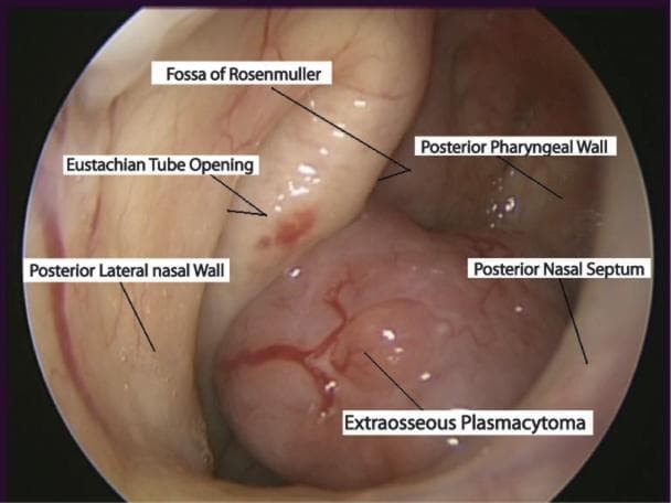 This diagnostic endoscopic image captures the nasopharynx, demonstrating an extraosseous plasmacytoma in a 75-year-old male. The primary finding is a large, smooth, fleshy pink-to-red mass protruding into the nasopharyngeal space. The mass exhibits prominent surface vascularity with branching vessels and is shown effacing the posterior pharyngeal wall. Key anatomical landmarks are annotated, including the Eustachian tube opening and the Fossa of Rosenmuller located superior to the lesion. The mass is positioned adjacent to the posterior nasal septum and the posterior lateral nasal wall. This clinical photograph illustrates the typical presentation of a rare extramedullary plasma cell neoplasm in the upper respiratory tract, which may present with symptoms such as epistaxis. The image serves as an educational resource for Otolaryngology and Oncology, highlighting the importance of endoscopic examination in evaluating nasopharyngeal masses.