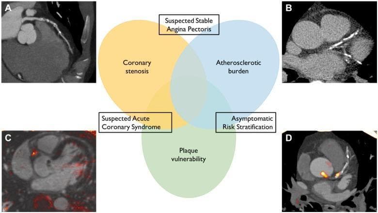A multi-panel medical infographic and diagnostic imaging collage illustrating non-invasive coronary imaging modalities. The central feature is a Venn diagram highlighting three clinical objectives: coronary stenosis assessment (yellow), atherosclerotic burden quantification (blue), and plaque vulnerability identification (green). Overlapping regions link these objectives to clinical scenarios such as suspected stable angina pectoris, suspected acute coronary syndrome, and asymptomatic risk stratification. Surrounding the diagram are four diagnostic images: (A) a computed tomography angiography (CTA) showing coronary vessel morphology; (B) a coronary artery calcium (CAC) scan highlighting high-density calcified plaques; (C) a T1-weighted magnetic resonance coronary angiography showing potential intracoronary thrombus or intraplaque hemorrhage; and (D) a positron emission tomography (PET) scan utilizing radioactive tracers to map metabolic markers of plaque instability, indicated by focal orange/red hotspots. This educational visual demonstrates the complementary roles of CT, MRI, and PET in cardiology for evaluating ischemic heart disease and vascular health.